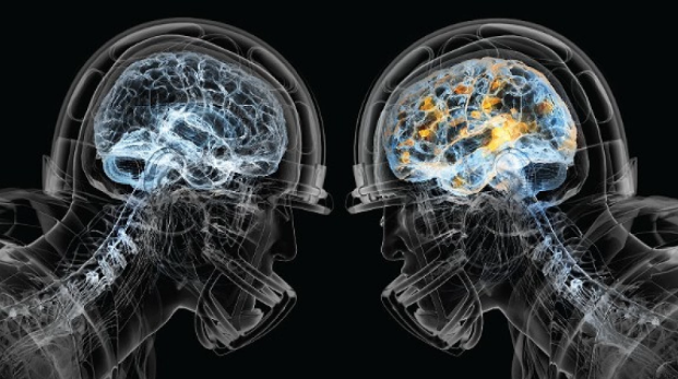 Chronic Traumatic Encephalopathy (CTE)
